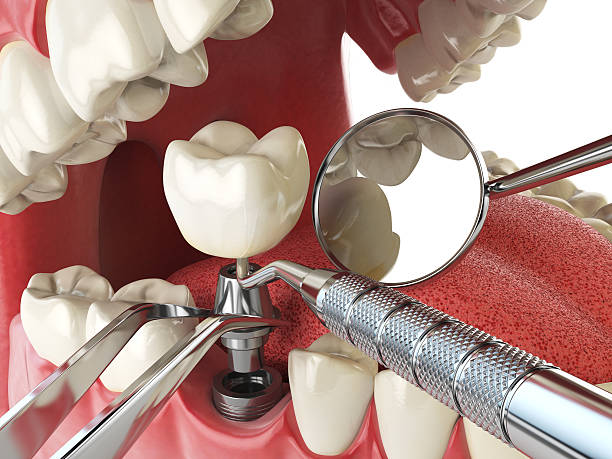 Best Emergency Root Canal Treatment in Pantego, TX